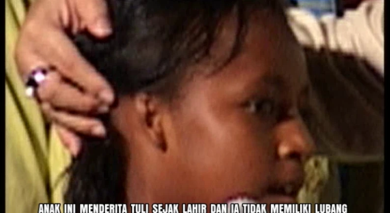Gallery Kesaksian 97 tuli_sejak_lahir_tanpa_lubang_telinga