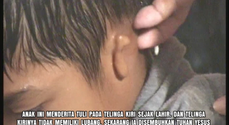 Gallery Kesaksian 101 tuli_telinga_kiri_sejak_lahir_tanpa_lubang_telinga